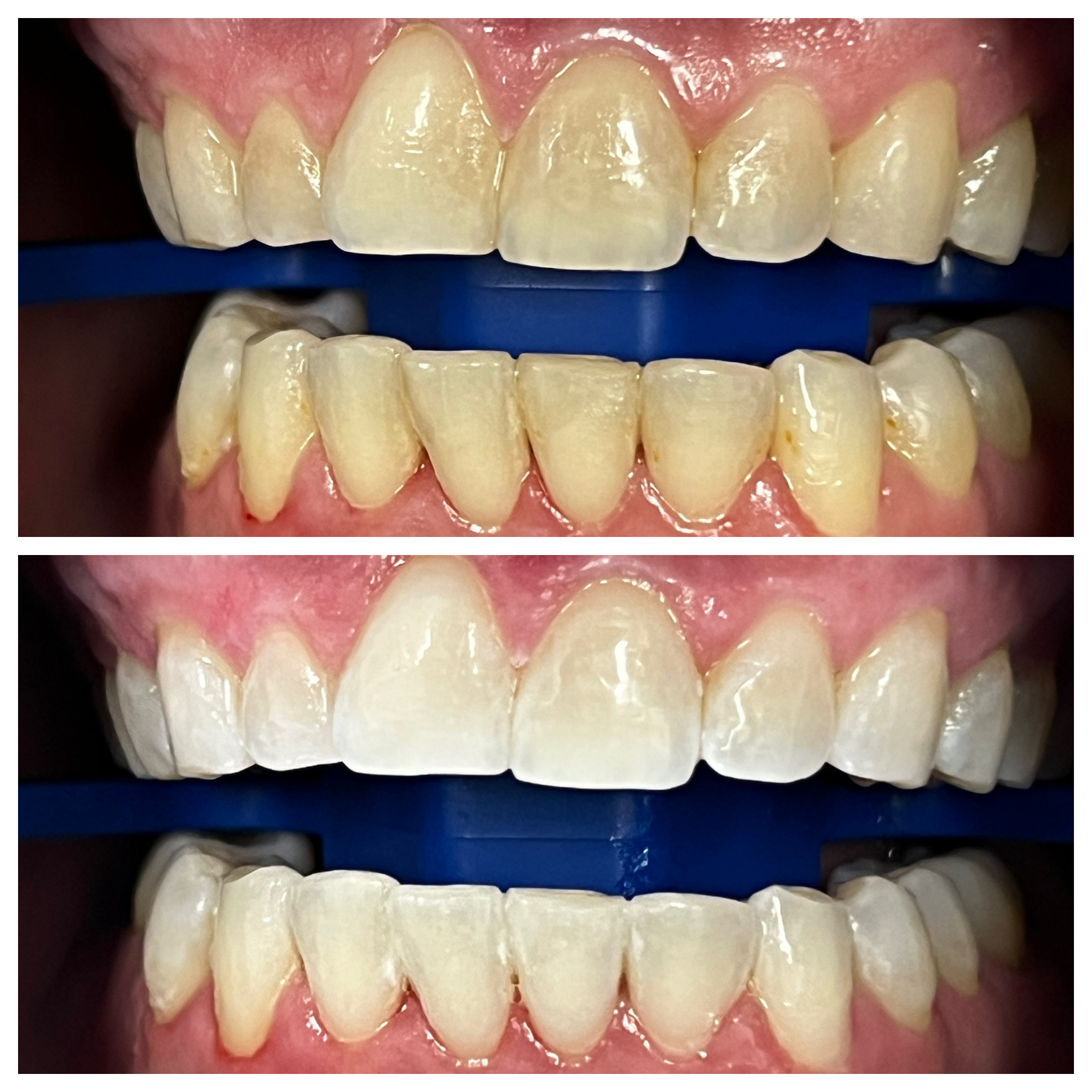 Smile Studio Shartel | Dermal Fillers, Veneers and Juvederm reg 