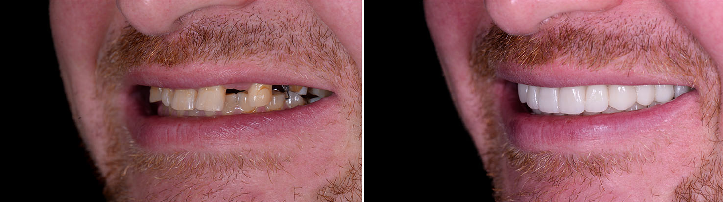 The image shows two photographs of a person with a beard and mustache, displaying their teeth before and after dental work, with the top photo showing a smile and the bottom one showing an open mouth revealing the completed dental procedure.